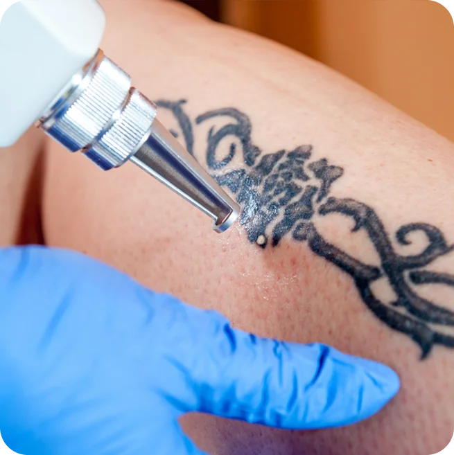 Advanced Laser Tattoo Removal by Expert Doctors at Elation Hair and Skin Care Clinic