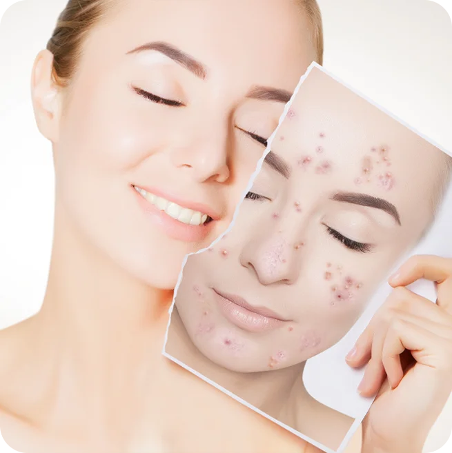 Anti-Acne Treatment with Advanced Lasers & Peels at Elation Hair and Skin Care Clinic