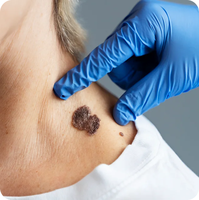 Advanced Mole, Wart, or Birthmark Removal at Elation Hair and Skin Care Clinic in Kolkata