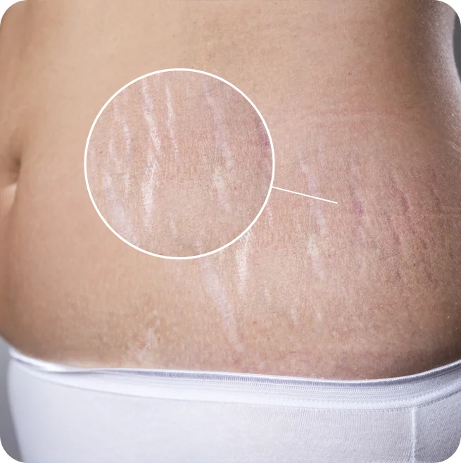 Advanced Stretch Marks Removal Treatment at Elation Hair & Skin Care Clinic in Kolkata